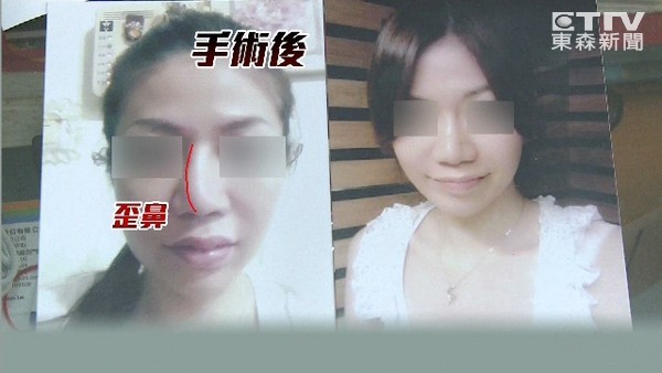臺灣女子花10多萬整鼻子 術后鼻子歪了 臺灣女子花10多萬整鼻子 術后鼻子歪了