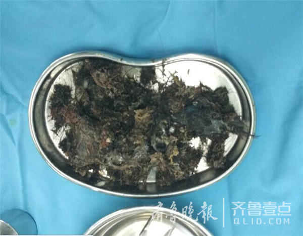 5歲女童愛偷吃頭發(fā) 胃里取出大量毛發(fā)結(jié)石 5歲女童愛偷吃頭發(fā) 胃里取出大量毛發(fā)結(jié)石