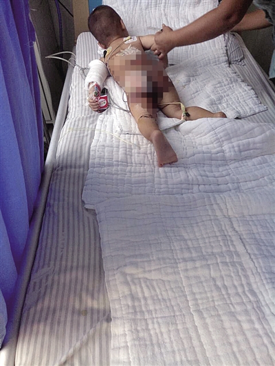 1歲男童掉進滾燙菜湯中 重度燙傷或影響發育 1歲男童掉進滾燙菜湯中 重度燙傷或影響發育