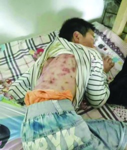 渾身傷痕的男孩(寧國網友供圖)