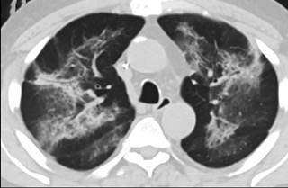 6天后的軸向CT平掃圖像顯示毛玻璃影變?yōu)閷嵶兒洼p度結(jié)構(gòu)扭曲。(同一病人CT影像)
