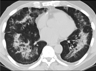 6天后的軸向CT平掃圖像顯示毛玻璃影變?yōu)閷嵶兒洼p度結(jié)構(gòu)扭曲。(同一病人CT影像)